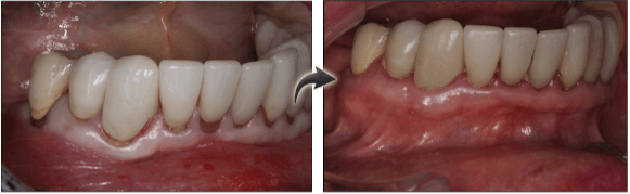 Pinhole Gum Surgery & Grafting in NYC and NJ