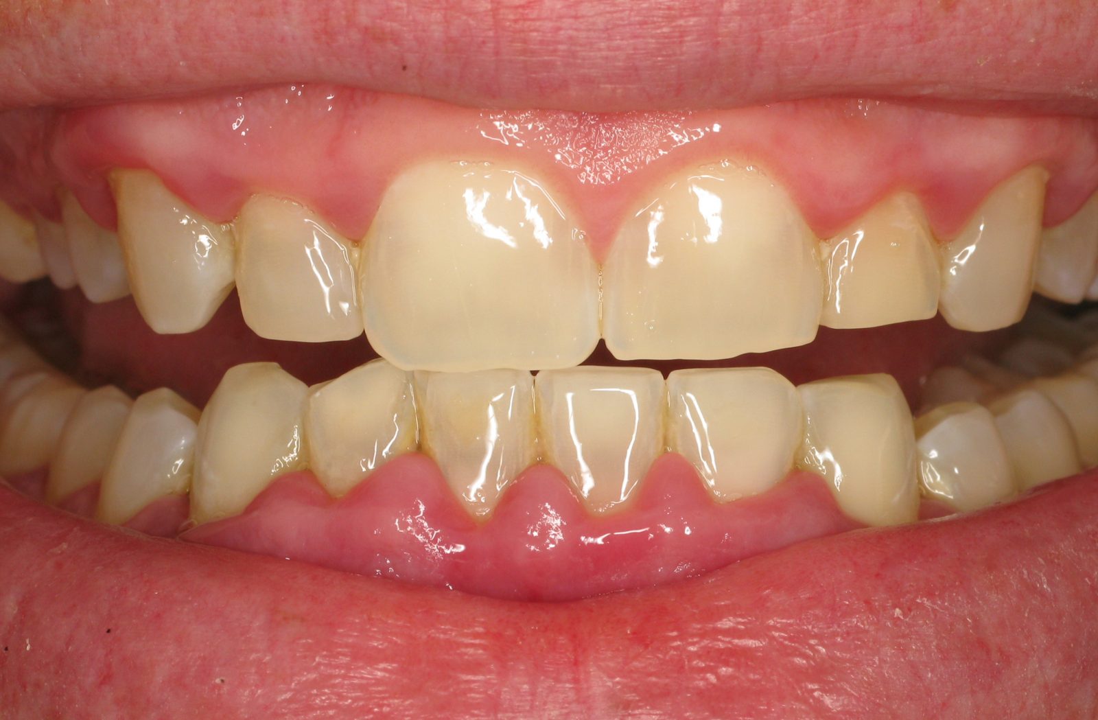 What is Periodontal Plaque? Laser Periodontics & Gum Surgery